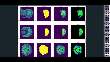 Supervised skull stripping and unsupervised GM, WM segmentation