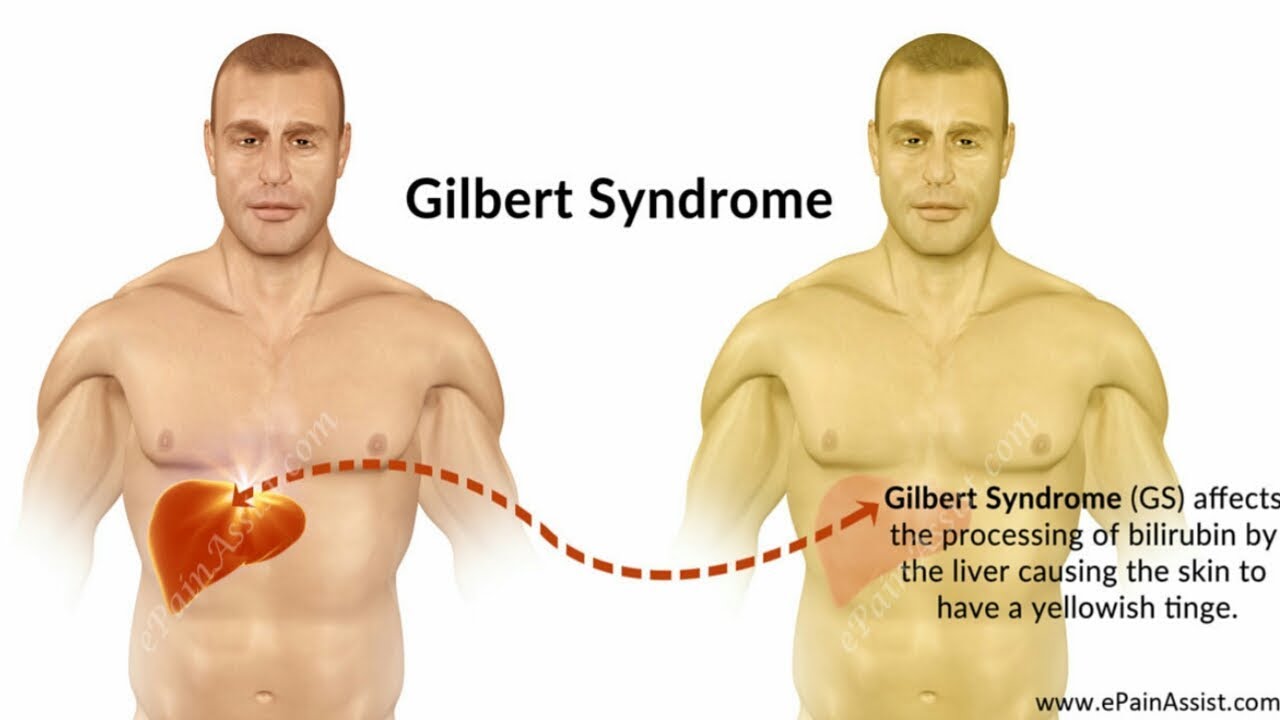 Печень синдром жильбера. Синдром Жильбера ген.