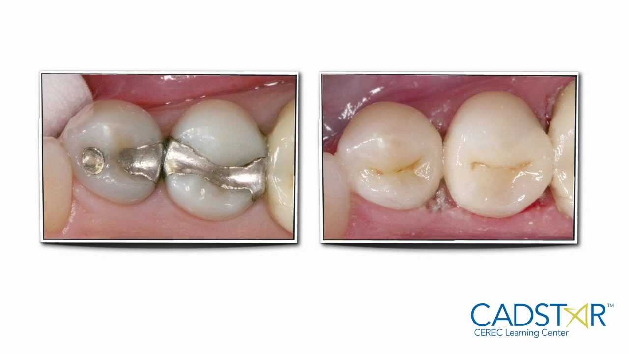 cerec inlays cerec inlays