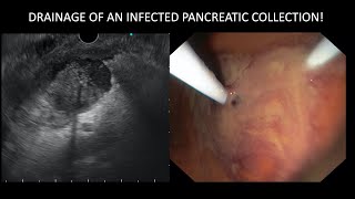 Drainage of walled-off necrosis with EUS.