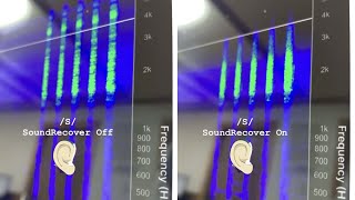 What is Frequency lowering(compression) in hearing aids feat. Phonak SoundRecover