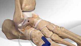 Chronic Ankle Instability| Chronic Ankle Sprain Repair With the InternalBrace| #3d #animation #surga