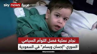 نجاح عملية فصل التوأم السيامي السوري إحسان وبسام في السعودية| مراسلو_سكاي| سكاي_السعودية