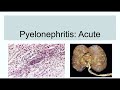 Pyelonephritis( Acute)