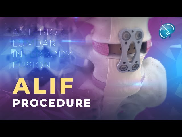 What is Anterior Lumbar Interbody Fusion? | ALIF class=