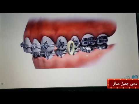 ترابط الأسنان أثناء تقويم الأسنان يوتيوب
