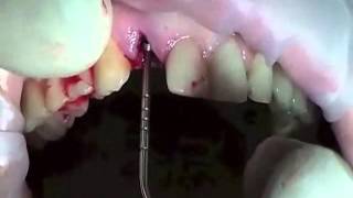 Имплантация зубов в Самаре(Стоматология АртСмайл63 предлагает имплантация зубов в Самаре по низким ценам. Подробней на сайте - http://artsmile..., 2014-06-04T04:56:31.000Z)
