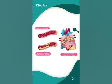 NURA оношилгооны төв зүрхний титэм судасны шохойжилтыг хэрхэн ...