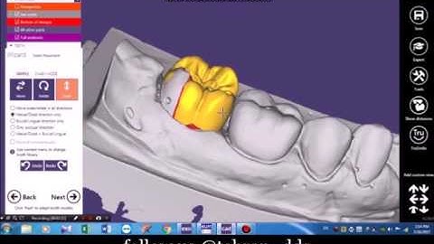 Onlay Exocad Design part 1