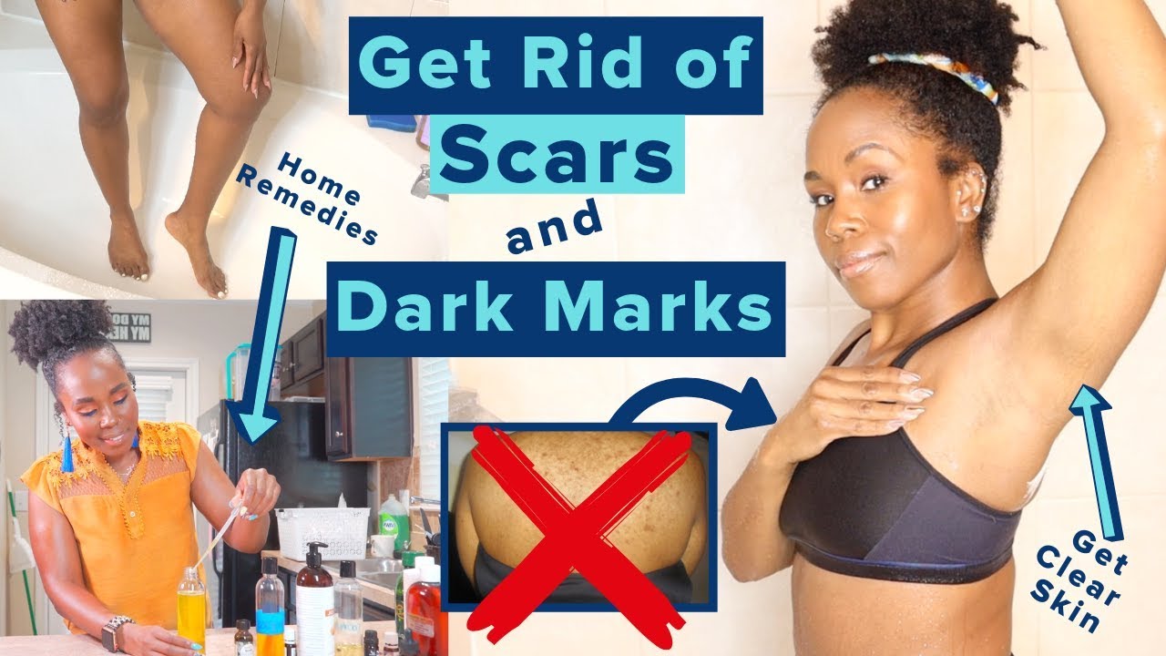 Get Rid of Hyperpigmentation, Scars, Dark Spots & Boil Scars on