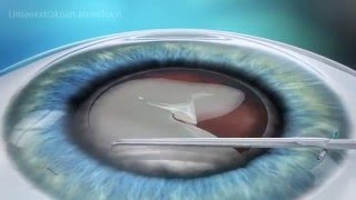 Informationsvideo Grauer Star - Augenklinik Luzerner Kantonsspital