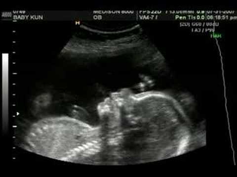 22 Pregnant with Twins: Ultrasound, and More » TwinStuff