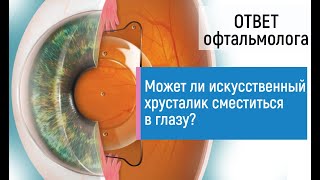 Может ли искусственный хрусталик после операции удаления катаракты сместиться в глазу или выпасть?