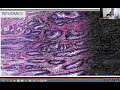 Machine Learning for Pathology - Lecture 19 - MIT Deep Learning in the Life Sciences (Spring 2021)