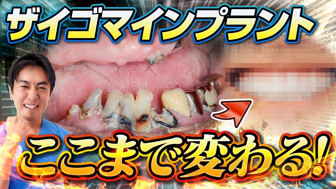 口元から笑顔に！ザイゴマインプラントの実際の症例を大公開！ - YouTube