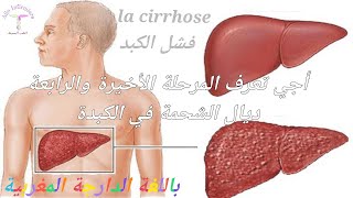تشحم الكبد المرحلة الرابعة و الأخيرة فشل الكبد/ la cirrhose