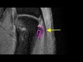 Thumb MRI: Stener-like lesion of the RADIAL collateral ligament