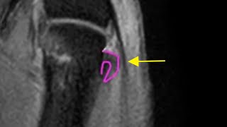 Thumb MRI: Stener-like lesion of the RADIAL collateral ligament