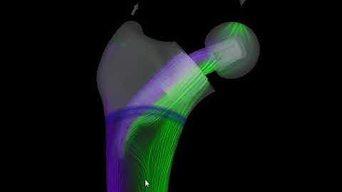 Stress Tensor Field Visualization for Implant Planning in Orthopedics