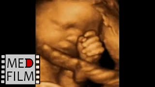 Малыш чешет нос, 31 неделя беременности, 3D УЗИ © The fetus scratches the nose