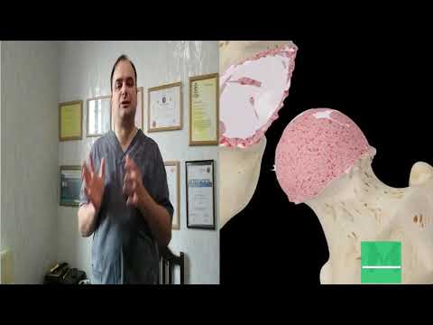 კოკსართროზის მკურნალობა