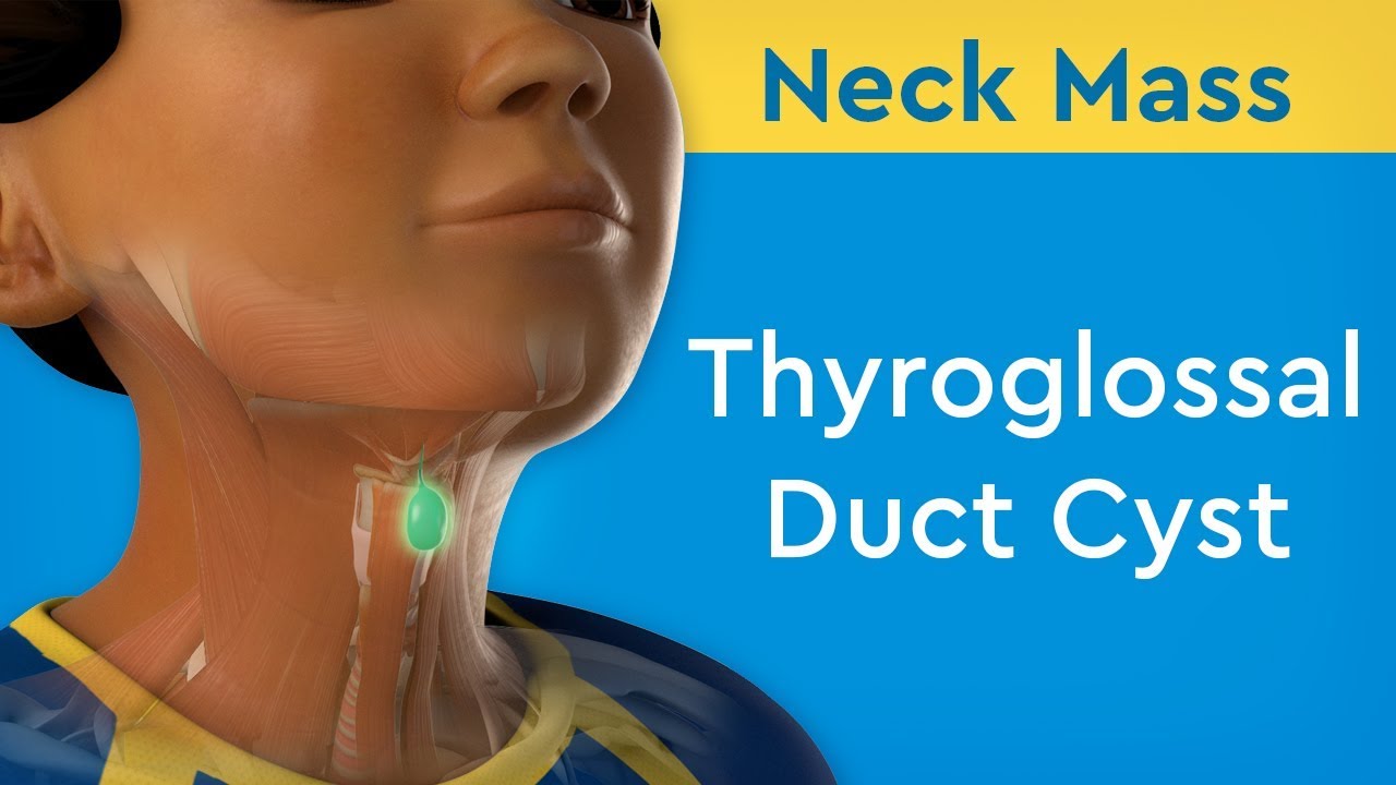 Thyroglossal duct cyst in adults