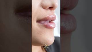 Kissable Lips Unlocked: Transform Thin to Full with Lip Fillers at Bellaviso! 💋✨ 050 500 1570