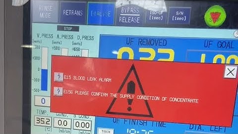 E15 & E156 Nipro surdial 55 plus dialysis machine alam solution Video