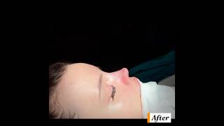 Closed Rhinoplasty With Dr Engin Erkal🌸🤗