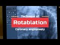 Rotablation angioplasty  dr anurag sharma  cardiologist  heart specialist  ojas hospital