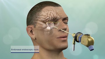 Updated Video Available: Keyhole Brain Tumor and Skull Base Surgery