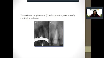 ¿Se ve en la radiografía la necesidad de una endodoncia?