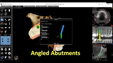 CS 3D Imaging Software - Using Angled Abutments