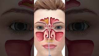Balloon Sinuplasty Procedure - To Open Blocked Sinus Passages #theflash #doctor #sinussurgery