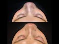 Primary Rhinoplasty for Severely Deviated Nose