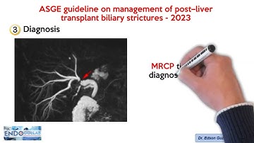 ASGE guideline on management of post–liver transplant biliary strictures - 2023