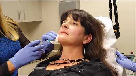 Dr Picerno Performs a Volbella Procedure