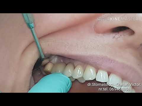 Stomatologie Chisinau,Botanica-TerraDent, Moldova! Diferenta dintre implant dentar si dinte natural.