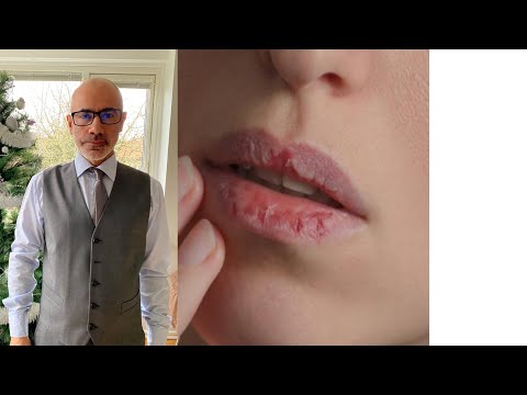 90 اسباب تشققات الشفاه وعلاجها الدورة السويدية للصحه