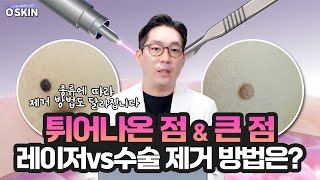 당신의 피부를 구원할 돌출점 제거 비밀 대공개!