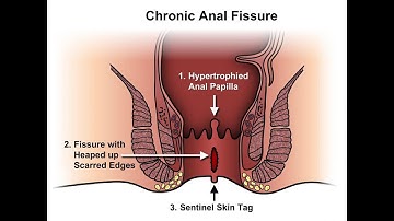 Curettage CPT code - simplify medical coding