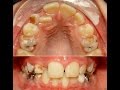 Orthodontic Treatment of Upper Impacted Canines - Dina 14yrs