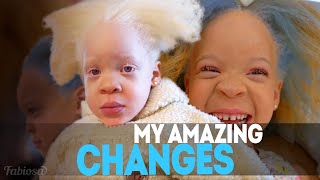 An Albino Girl's Surprising Journey to Change Her Life Forever!