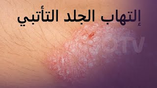 ما هو التهاب الجلد التأتبي المعروف بالأكزما؟