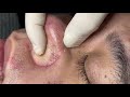 Removing blackheads from nose with haris beauty  2022