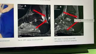 Разбор МРТ мастера спорта по паурлифтинг. Постановка диагноза тендопатия