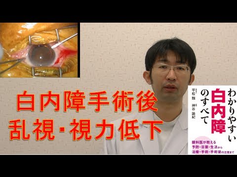 白内障手術後の乱視・メガネ・老眼・視力低下について