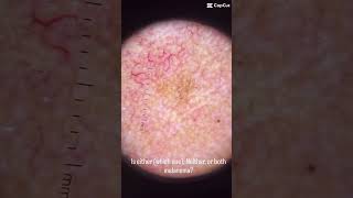 Do you think these lesions are melanoma? If so, which one? Some great learning cases at the this