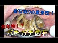 【歯石取り】数年ものの歯石を除去！定期検診は大切です。