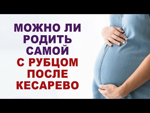 Если есть рубец от кесарево, значит только кесарево? Можно ли родить самой с рубцом от кесарево?